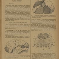0411 - Page 409 - Sur quelques cas de tumeurs cérébrales ; par M. L. Babonneix... / I. Étude analytique de nos cas
