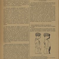 0420 - Page 418 - Sur quelques cas de tumeurs cérébrales ; par M. L. Babonneix... II. Synthèse générale / Les lordo-cyphoses souples de l'adolescence et leur traitement ; par M. Lance...