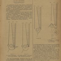 0483 - Page 481 - Un procédé de cure radicale de la hernie inguinale ; par André Folliasson...