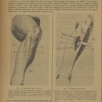 0866 - Page 864 - Les ligatures difficiles ; par H. Billet... Ligature des l'artère tibiale antérieure au tiers supérieur de la jambe