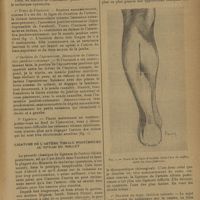 0867 - Page 865 - Les ligatures difficiles ; par H. Billet... Ligature des l'artère tibiale antérieure au tiers supérieur de la jambe / Ligature de l'artère tibiale postérieure au niveau du mollet