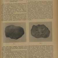 1283 - Page 1281 - La nécrose de la voute crânienne chez les épileptiques ; par M. A. Cange...