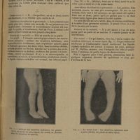 0929 - Page 921 - Diplégie spasmodique familiale ; par MM. L. Babonneix et M. Lance