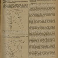 1319 - Page 1311 - Revue générale. La luxation traumatique inféro-interne de l'épaule ; par Roger Pétrignani... Définition / Fréquence / Etiologie / Mécanisme