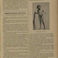 0735 - Page 731 - Bases actuelles de la parathyroïdectomie dans certaines polyarthrites ankylosantes ; par René Leriche et Adolphe Jung... / Hémihypertonie infantile ; par MM. L. Babonneix et A. Thévenard