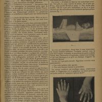 1189 - Page 1185 - Rhumatisme chronique déformant chez une petite fille de 4 ans ; par L. Babonneix et Mlle Fr.-B. Lévy