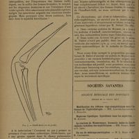 1192 - Page 1188 - Rhumatisme chronique déformant chez une petite fille de 4 ans ; par L. Babonneix et Mlle Fr.-B. Lévy / Sociétés savantes. Société médicale des hôpitaux. (Séance du 10 juillet 1931). Immunité antimorbilleuse naturellement acquise et anergie grippale. M. Le Bourdellès