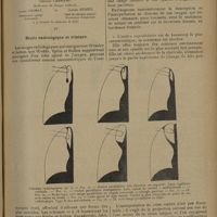 1369 - Page 1365 - Revue générale. Le lobe apical de la veine azygos ; par MM. Georges Carrière..., Louis Thomas... et Claude Huriez... IV. Étude radiologique et clinique