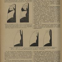 1372 - Page 1368 - Revue générale. Le lobe apical de la veine azygos ; par MM. Georges Carrière..., Louis Thomas... et Claude Huriez... IV. Étude radiologique et clinique / V