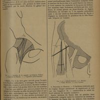 1479 - Page 1475 - Revue générale. Voies d'abord de l'articulation de la hanche ; par MM. A. Folliasson... et M. Joly... Les voies d'abord. Classification / Technique des principales voies d'abord