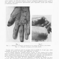 0196 - Page 194 - Travaux originaux. Dermatose verruqueuse " monitrice " d'un cancer viscéral, par Mm. H. Gougerot et B. Duperrat