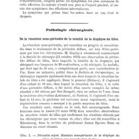 0098 - Page 98 - Revue générale. Pathologie médicale. Cancer encéphaloïde des poumons, par Georges W. Gay. (Boston med. and surgical Journal, janvier 1876) / Pathologie chirurgicale. De la résection sous-périosté de la totalité de la diaphyse du tibia