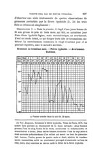 Grossesse au troisième mois. — Fièvre typhoïde. — Avortement. Guérison. + Fausse couche dans la nuit [...]