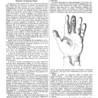 1369 - Page 651 - Mercr. méd. Clinique chirurgicale. Hôpital de la Pitié. - M. le professeur Le Fort. Panaris syringomyélique