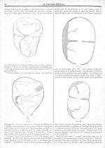 Fig. 61 / Fig. 62 / Fig. 63 / Fig. 64 [De la situation des oeufs et des foetus dans la grossesse gém [...]