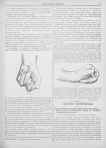 Fig. 94. - [Hospice de la Salpêtrière. - M. Charcot. Sur un cas de contracture spasmodique d'un memb [...]