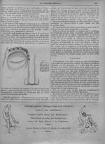 Fig. 7. - Suture terminale avec le bout de mèche sortant par la place suturée au niveau de l'angle i [...]