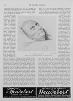 Broussais mort. Dessin de A. Gourlier. Eau-forte de Charles Blanc - Le progrès médical