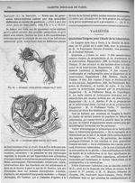 Fig. 41. Grossesse extra-utérine rompue au 3e mois/ Fig. 42. Grossesse extra-utérine au 7e mois - Ga [...]