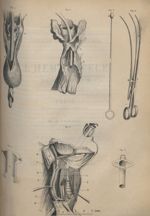 Fig. 1. Cette figure, destinée à montrer un diverticulum pharyngo-oesophagien est empruntée à Ledlow [...]