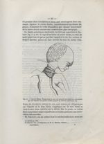 Fig. 4. Cas de Blume. Foetus dont le cou est entouré par plusieurs circulaires qui ont déprimé les p [...]