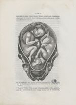 Fig. 8. Représentant deux jumeaux, dont l'un se présente par le siège et l'autre par le sommet, ento [...]