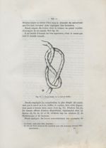 Fig. 11. Noeud double ou en huit de chiffre - Des dispositions du cordon (la procidence exceptée) qu [...]