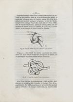 Fig. 14. Noeud de Lyman tel qu'il a été trouvé à la naissance / Fig. 15. Noeud de Leyman. Forme inte [...]