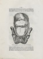 Fig. 18. Circulaires avec un noeud ; figure tirée de Smellie - Des dispositions du cordon (la procid [...]