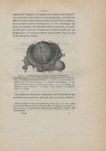 Fig. 1. Tumeurs fibreuses multiples (d'après Cruveilhier) - Des fibromes utérins au point de vue de  [...]