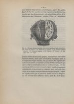 Fig. 6. Tumeur fibreuse contenant des cavités (géodes) (d'après Cruveilhier) - Des fibromes utérins  [...]