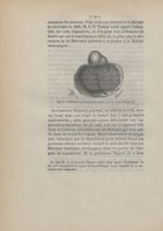 Fig. 7. Placenta partiellement inséré sur un corps fibreux - Des fibromes utérins au point de vue de [...]