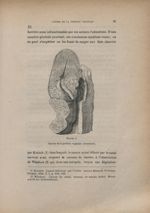 Figure 4. Cancer de la portion vaginale (Gusserow) - Du cancer Utérin pendant la grossesse et l'acco [...]