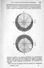 Fig. 24 et 25. Amblyopie légère, diplopie monoculaire et rétrécissement très accentué du champ visue [...]