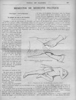 Fig. 1. Palpation du rein : procédé du ballottement rénal de Guyon / Fig. 2. Palpation du rein : pro [...]