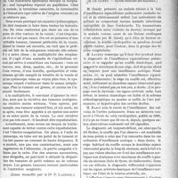 1306 - Page 1309 - Partie scientifique. Clinique chirurgicale, Hôpital Necker : M. le professeur Legueu. II, Tumeur pupillaire de la vessie / Revue des sociétés savantes. Insuffisance sigmoïdienne pulmonaire et rétrécissement mitral, (M. Ch. Gandy. — Société médicale des hôpitaux)