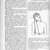 1727 - Page 1734 - Partie scientifique. Travail original. Chirurgie esthétique. Traitement du torticolis. La ténotomie à ciel ouvert esthétique, par le Dr J. Fiévez. La ténotomie / Appareillage et soins consécutifs