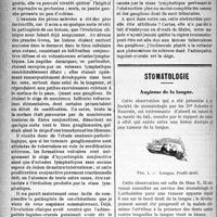 0277 - Page 276 - Partie Scientifique. Clinique chirurgicale, Hôtel-Dieu de Toulouse. — M. J. P. Tourneux. L'éléphantiasis de la vulve / Stomatologie. Angiome de la langue