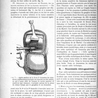 0569 - Page 884 - Partie scientifique. Le traitement chirurgical endocranien de la névralgie du trijumeau, par le Docteur J. Bourguet. Ablation du ganglion de Gasser / Neurotomie rétro-gassérienne