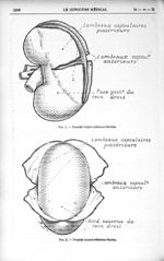 Fig. 1. - Procédé Guyon-Albarran-Marion / Fig. 2. – Procédé Guyon Albarran Marion - Le Concours médi [...]