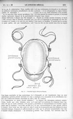 Fig. 3. - Procédé Guyon-Albarran-Marion - Le Concours médical