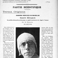 1975 - Page 1921 - Propos du jour. La dissimulation administrative des maladies contagieuses. La peste à Paris en 1920 [J. Noir] / Partie scientifique. Travaux Originaux. Journées médicales de Bruxelles. Causerie Chirurgicale. La greffe anthropoïdo-anthropique ou greffe testiculaire du singe à l’homme, par M. Dartigues (30 juillet 1924)