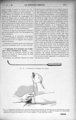 Fig. 6. - Explorateur métallique de Guyon / Fig. 7. - L’explorateur métallique est introduit dans l’ [...]