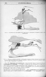 Fig. 8. - La traction de la main gauche sur la verge permet à l’instrument de progresser- jusqu’à la [...]