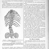 2610 - Page 2333 - Partie scientifique. Travaux Originaux. Morphologie clinique. Les malformations costales, par le Dr. Louis Dubreuil-Chambardel. Les unions costales / Les côtes en anneau