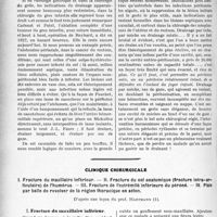 3599 - Page 3306 - Partie scientifique. Travaux Originaux. Indications et technique du Drainage en chirurgie abdominale, par J. de Fourmestraux / Clinique chirurgicale. I. Fracture du maxillaire inférieur. — II. Fracture du col anatomique (fracture intra-articulaire) de l’humérus. — III. Fracture de l’extrémité inférieure du péroné. — IV. Plaie par balle de revolver de la région thoracique en séton, d’après une leçon du prof. Hartmann