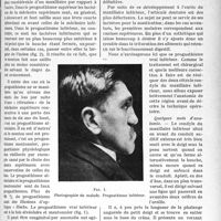 0834 - Page 823 - Partie scientifique. Le traitement chirurgical du prognathisme inférieur par le procédé de jaboulay. — aperçu sur les autres méthodes, par le Dr Julien Bourguet