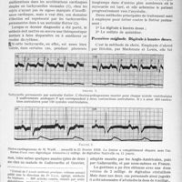 1052 - Page 1039 - Partie scientifique. Travaux Originaux. Traitement des tachycardies paroxystiques, par Camille Lian et O. Viau