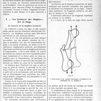 0462 - Page 461 - Partie scientifique. Travaux Originaux. Les fractures des membres dans la pratique journalière, (Conseils thérapeutiques), par M. Raphaël Massart. La période de consolidation / Les fractures des diaphyses des os longs