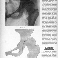 0561 - Page 560 - Partie scientifique. Travaux originaux. La pratique orthopédique de l’enfant et de l’adulte, Dr Raphaël Massart. Les affections non tuberculeuses de la hanche chez l’enfant. Arthralgies. Douleurs de croissance
